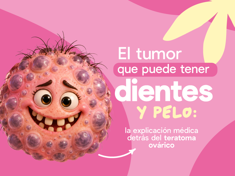 El tumor que puede tener dientes y pelo: la explicación médica detrás del teratoma ovárico